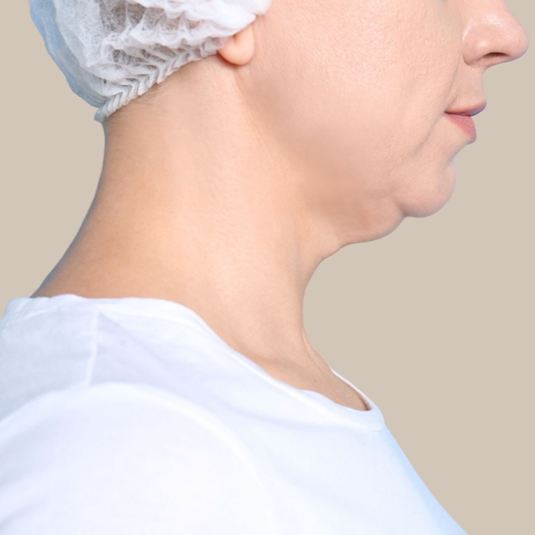 Fjerning av Dobbelthake