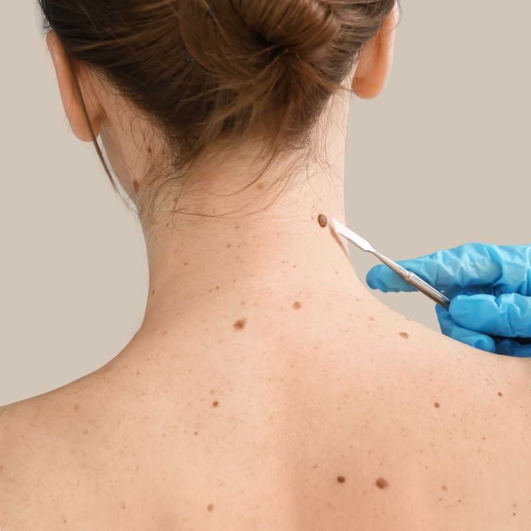 Fjerning av hudtagger (skin tags)
