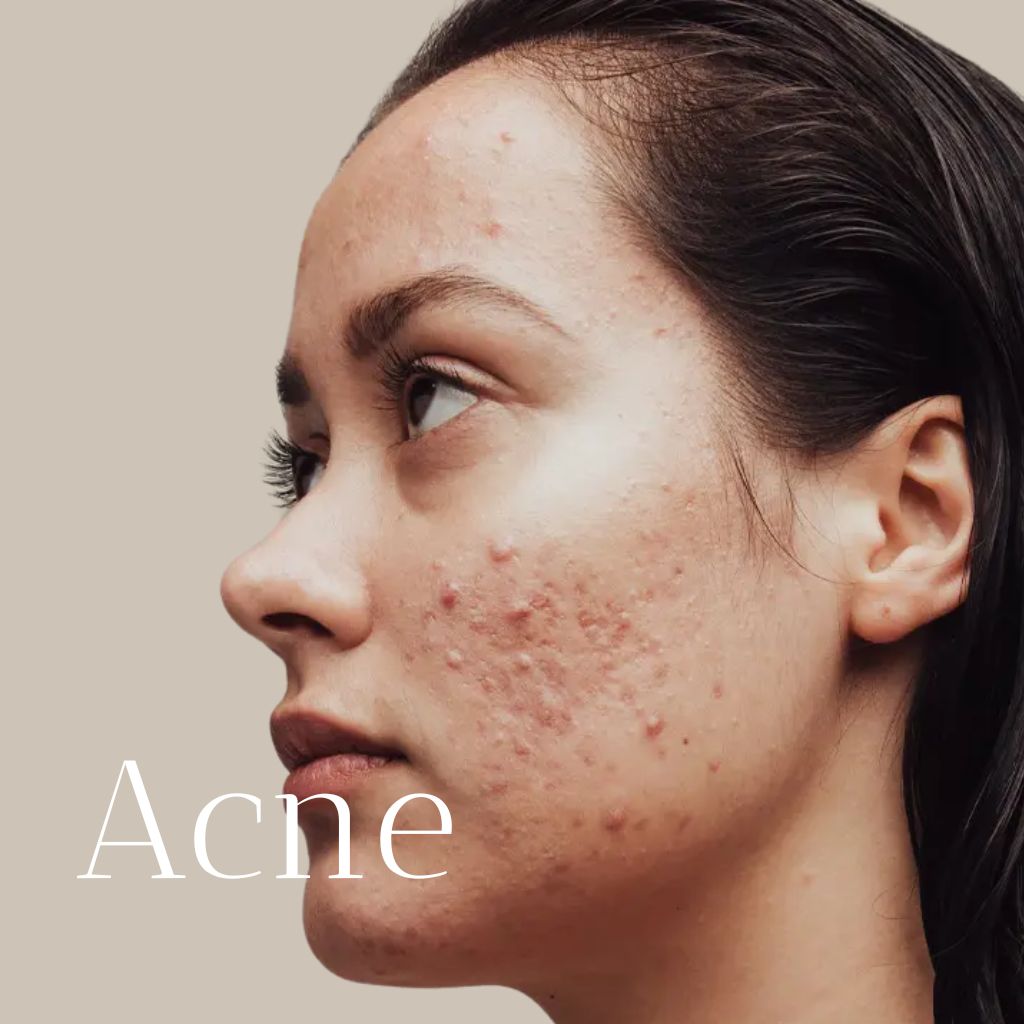 Aerolase® Akne